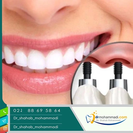 تجربیات واقعی بیماران در مقایسه با باورهای غلط درباره ایمپلنت دندان